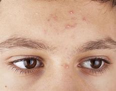 Image result for Pustule Pimple