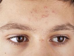 Image result for Infected Acne Pustules