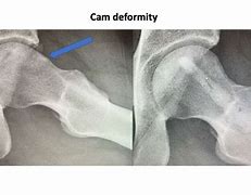 Image result for Deformity of Fibular Head