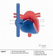 Image result for Unbalanced AV Canal