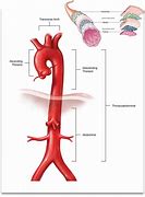 Image result for Aortic Vessels