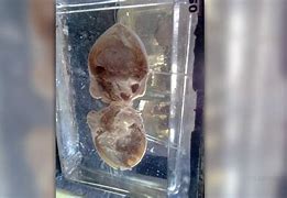 Image result for Teratoma Hair