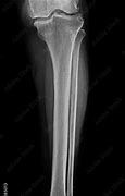 Image result for X-ray of Leg with Metal Plates