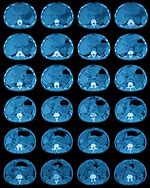 Image result for Abnormal Spleen CT Scan