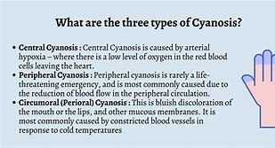 Image result for Cyanosis Legs