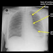 Image result for Aortic Rupture CXR