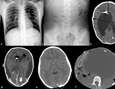 Image result for Brain Shunts Hydrocephalus