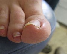 Image result for Ingrown Nail