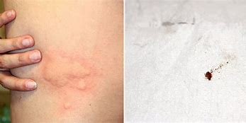 Image result for Bed Bug Bites Groin