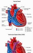 Image result for Atrioventricular Septum