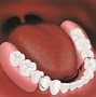 Image result for Bottom Dentures