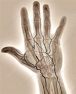 Image result for Hand Angiogram