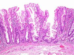 Image result for Sessile Thrombus