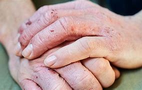 Image result for Eczema On Hands