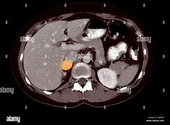 Image result for Large Pheochromocytoma CT