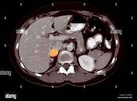 Image result for Pheochromocytoma On CT Scan