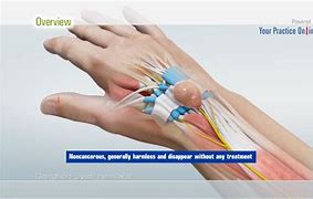 Image result for Cyst On Wrist