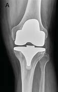 Image result for Left Knee Arthroplasty