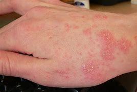 Image result for Wasll Mites