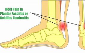 Image result for Heel Pain Plantar Fasciitis Sandals