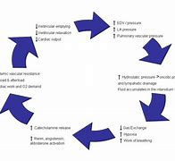 Image result for Acute Pulmonary Oedema Positioning