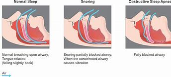 Image result for Osa Sleep Apnea