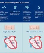 Image result for Atrial Fibrillation On the Body