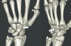 Image result for Capitate Bone Fracture