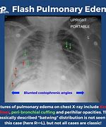 Image result for Acute Pulmonary Oedema and Fluid Overload