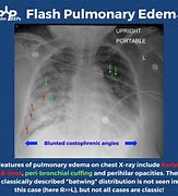 Image result for Acute Pulmonary Oedema Positioning