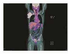 Image result for Hodgkin Lymphoma PET/CT