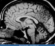 Image result for Ataxia MRI