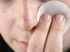 Image result for Pustules On Nose