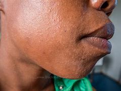 Image result for Eczema On Darker Skin