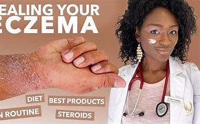 Image result for Eczema On Darker Skin