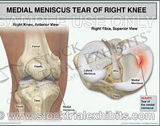 Image result for Right Knee Meniscus