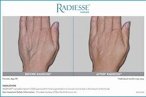 Image result for Radiesse for Hands