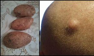 Image result for Cyst White Paste