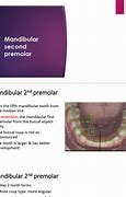 Image result for Mandibular 2nd Pre Molar