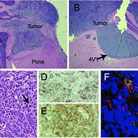 Image result for Shh Pathway Medulloblastoma