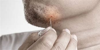 Image result for Ingrown Hair Causing Boils