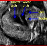 Image result for Abnormal Fetal Heart Ultrasound