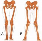 Image result for Lateral Knee Pain with Internal Rotation