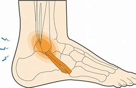 Image result for Peroneal Tendinopathy