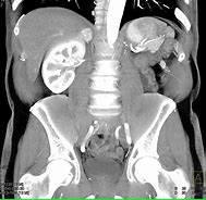 Image result for Pheochromocytoma On CT Scan