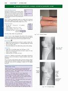 Image result for PA Oblique Lateral Rotation Knee