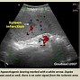 Image result for Spleen Infarction Ultrasound