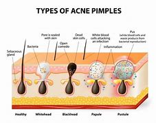 Image result for Pustules and Inflammatory Acne