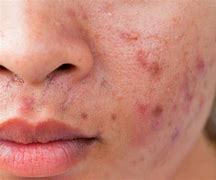 Image result for Mites On Face