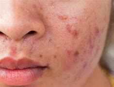 Image result for Mites Living On Face